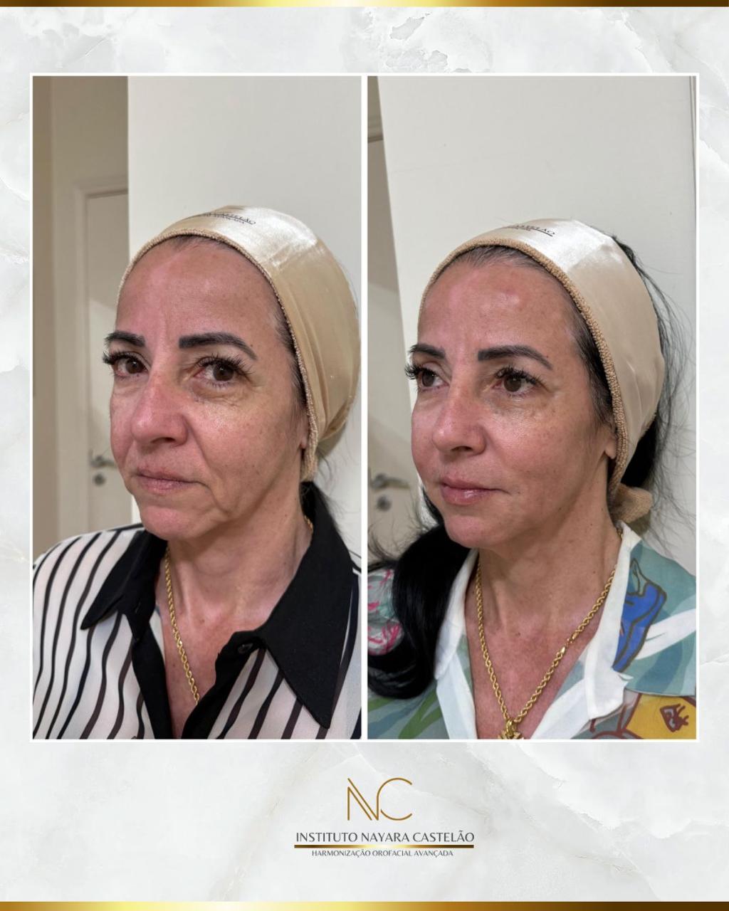 Antes e depois — harmonização facial completa